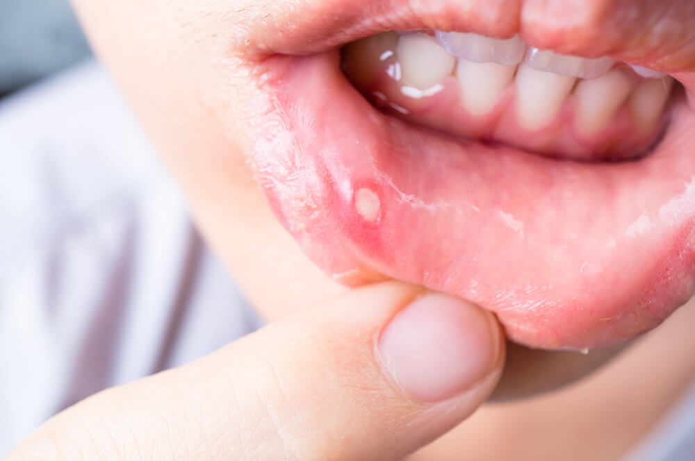 Should I Worry About Mouth Ulcers Redmires Dental Care Website